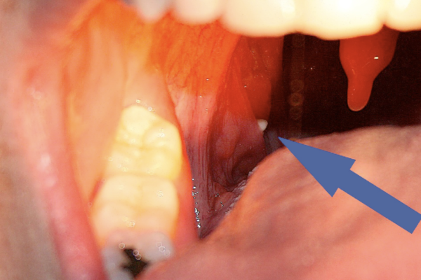 Tonsil Stones Removal – How you can Get Rid of Tonsil Stones Safely at Home?