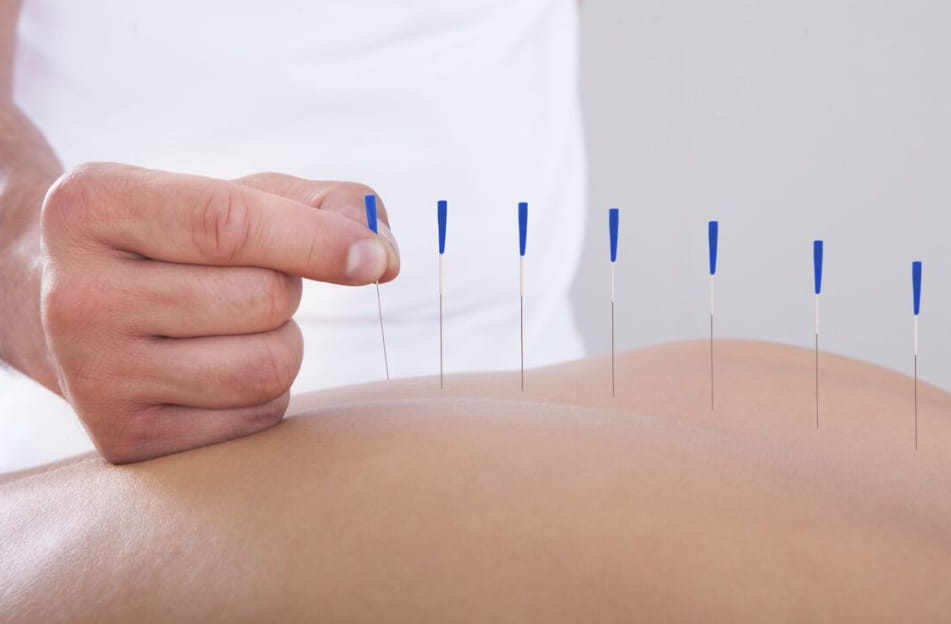 acupuncture therapy kingscliff