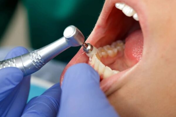 Battling Bacteria: Winning the Fight Against Tooth Implant Infections