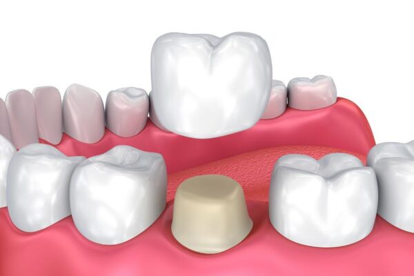 7 Crucial Benefits of Opting For Dental Crowns