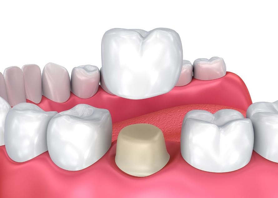 dental crowns