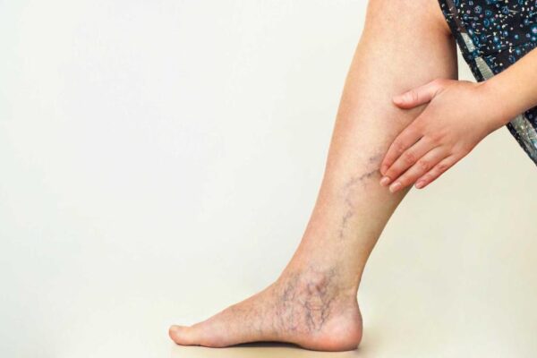 7 Ways How Varicose Vein Injection Works: A Comprehensive Guide