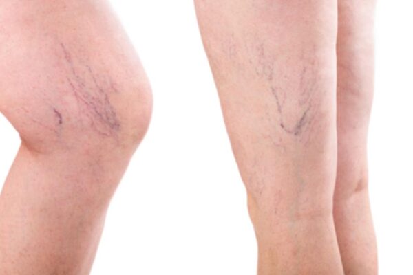 The Science Behind Vein Injections: How They Treat Varicose Veins