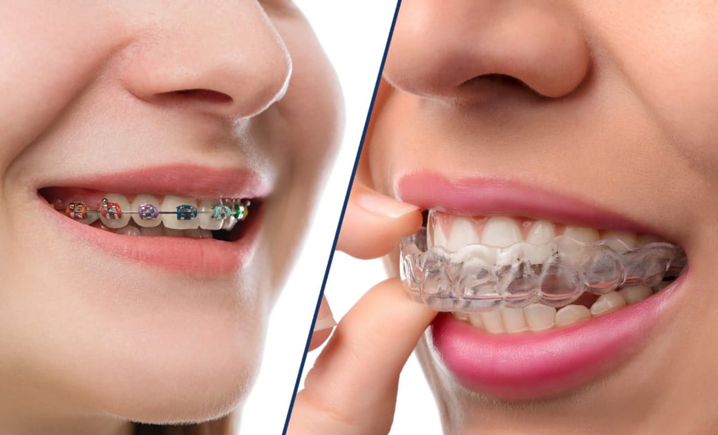 Invisalign treatment